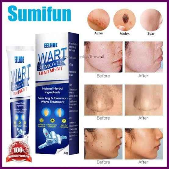 Wart Remover Ointment 20gm - BD Drop